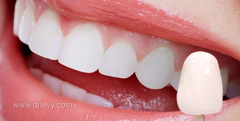 Dr. Joseph S. Levy: Porcelain Dental Veneers